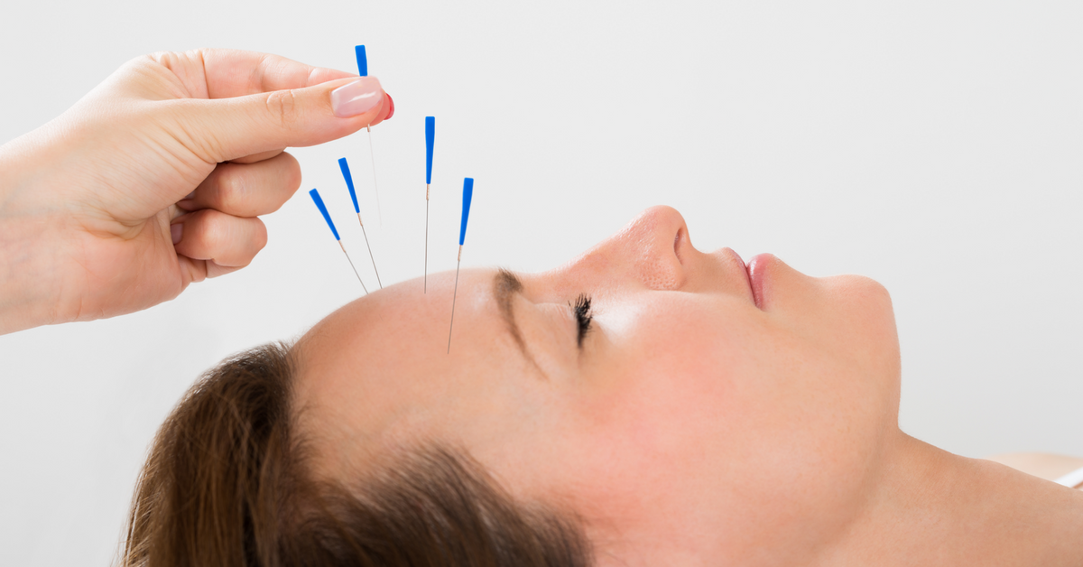 Chinese Acupuncture For Migraine