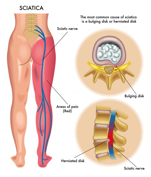 Natural Treatments for Sciatic Pain