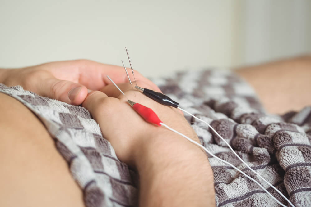 electro-acupuncture for mental health