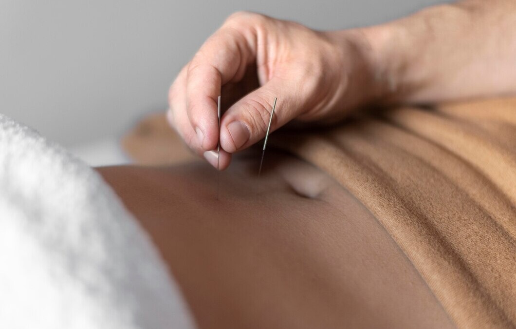 Acupuncture for Acid Reflux and GERD