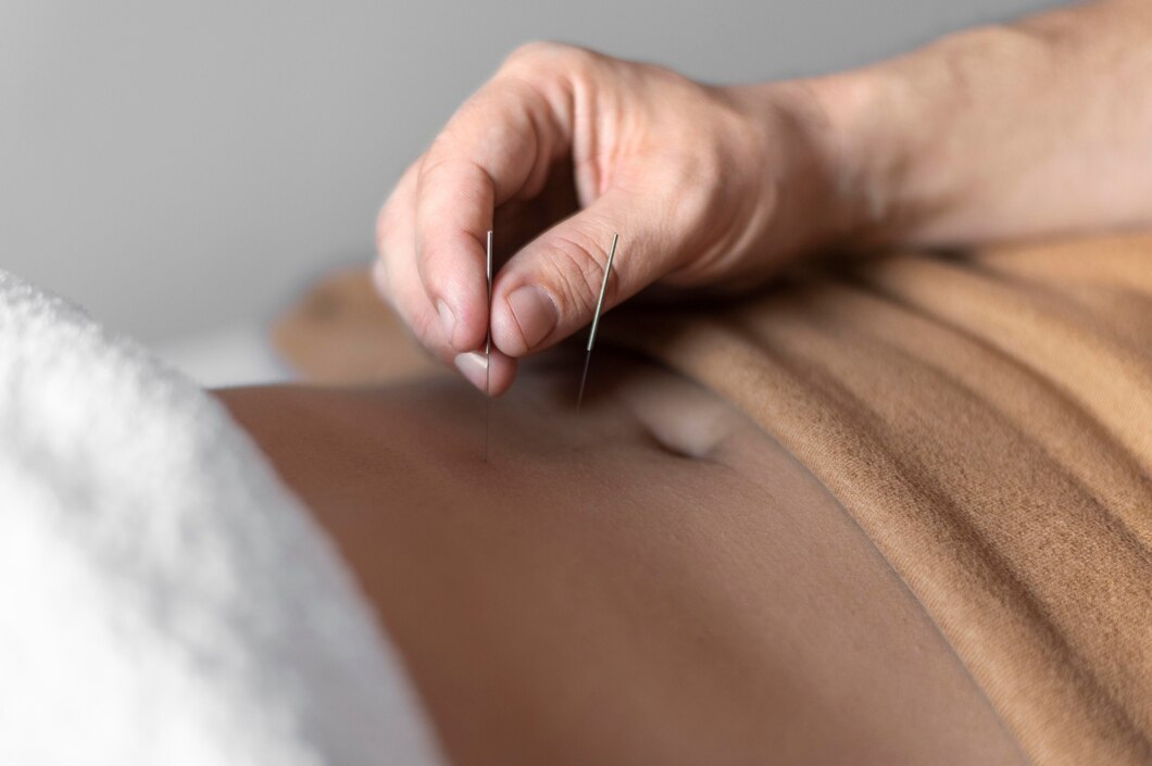 acupuncture for acid reflux and gerd